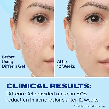 Differin Acne Kit, Retinoid Treatment Gel + Pimple Patches, 15g