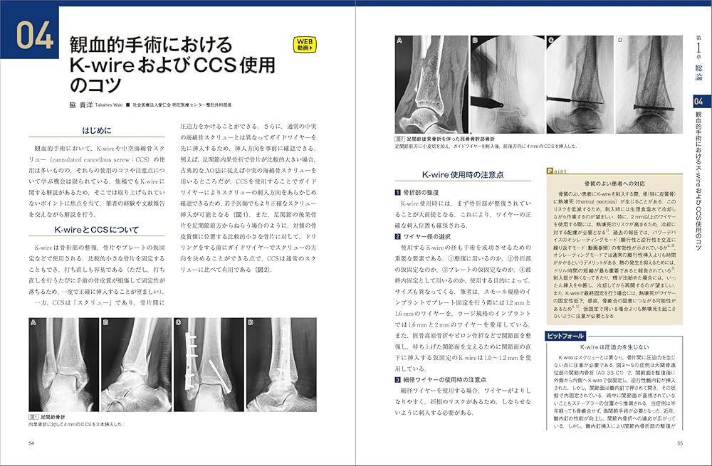 骨折のピンニングと経皮的スクリュー固定 : 経皮テクニック完全攻略　裁断済み 骨折のピンニングと経皮的スクリュー固定： 経皮テクニック完全