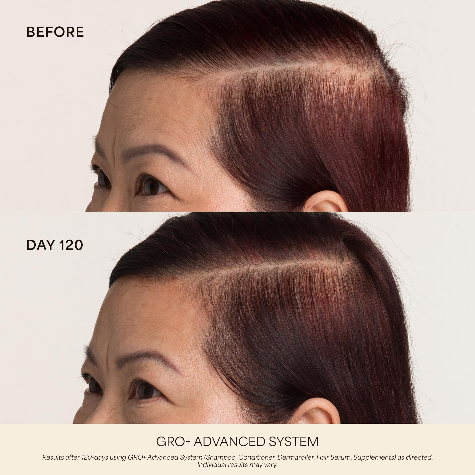 VEGAMOUR Scalp Dermaroller - MD-Developed, 1,200 Medical-Grade Needles, Enhances Serum Absorption, Twist-On Replaceable Head, Protective Case Included