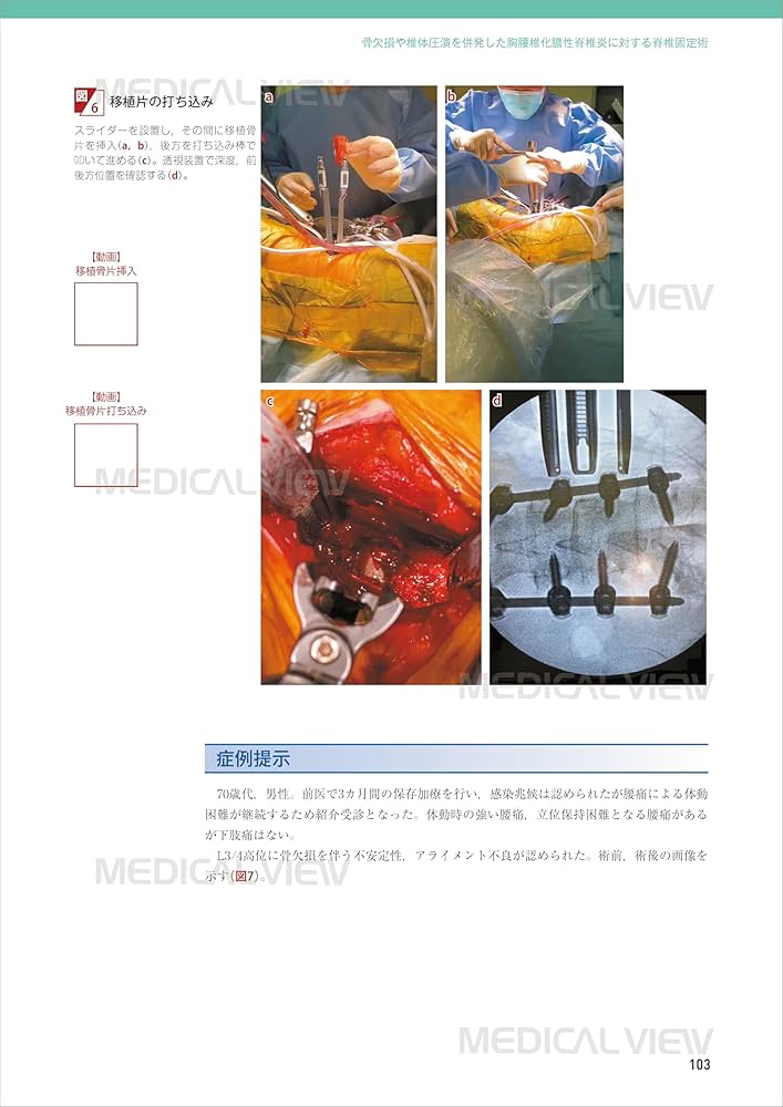 【裁断済み】OS NEXUS13 脊椎の再建法―すべり症から脊柱変形まで メジカルビュー社｜整形外科｜新OS NEXUS No.13 脊椎の再建法