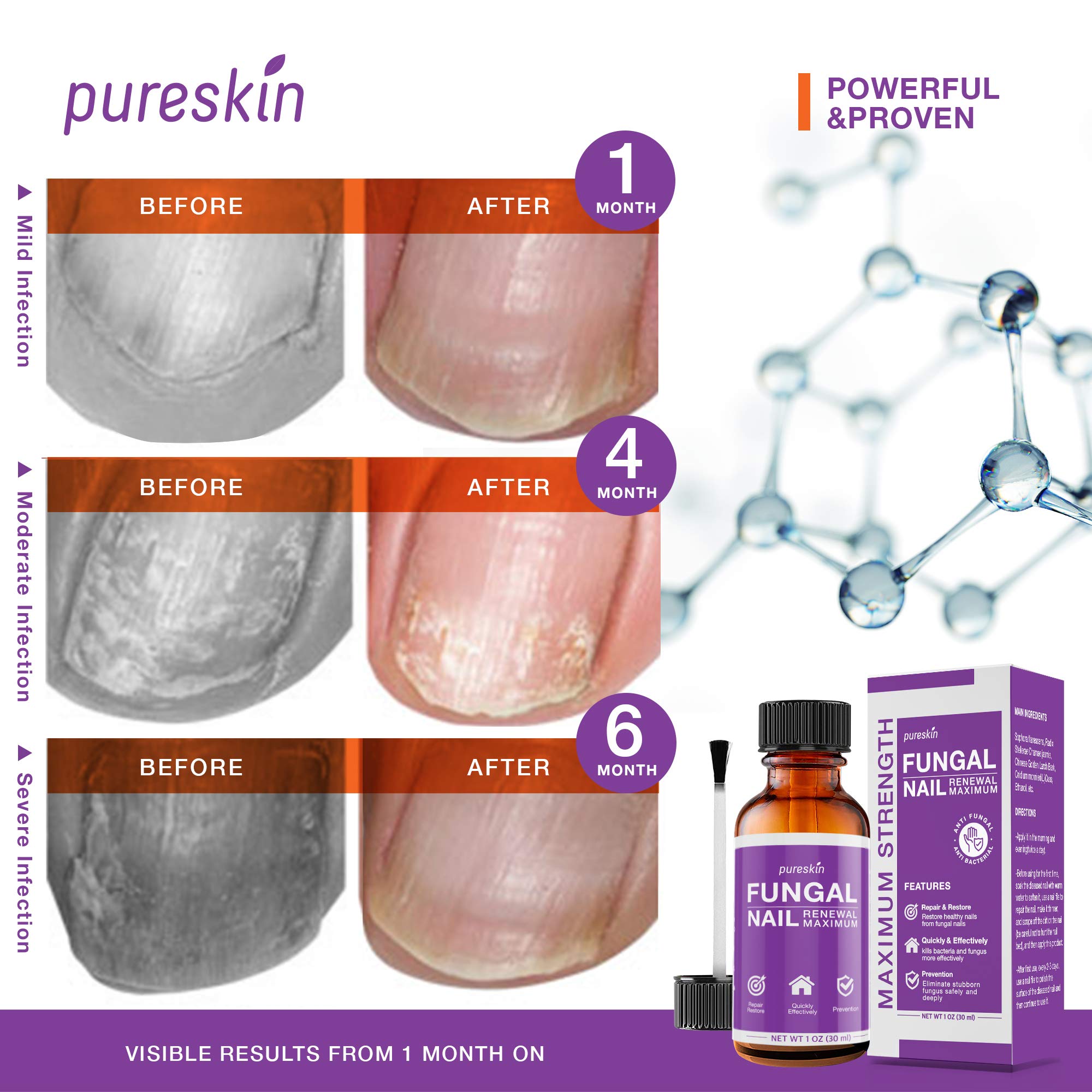 Buy pureskin Fungal Nail Renewal Maximum Strength Nail Fungus
