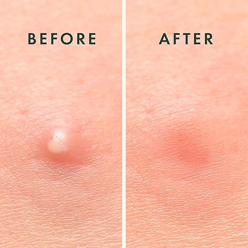 Miniatura 8 de Rael Miracle Overnight Spot Cover  Más gruesa y extra adherencia parches hidrocoloides para espinillas de acné calcomanías de manchas para cara