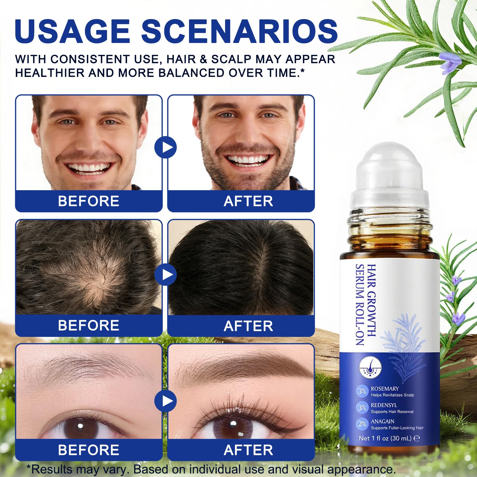 Hair Growth Serum Roll On, Huile et sérum de croissance capillaire au romarin 3%, Redensyl 3%, Anagain 2% - Nourrit les follicules pileux et le cuir chevelu - 30 ml