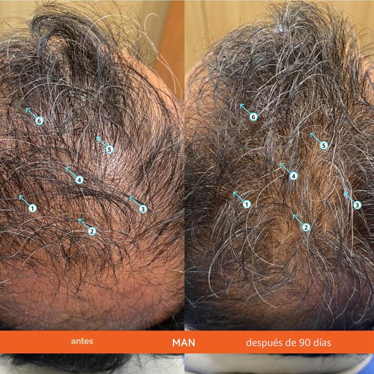 DS Laboratories - Revita Champú para Adelgazamiento del Cabello 925 ml, Evita la Caída del Pelo, Estimula el Crecimiento Cabello, Mejora el Grosor, Longitud y Calidad, Sin Sulfato, Bloqueador de DHT