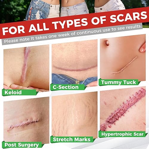 Miniatura 5 de Hojas de silicona para cicatrices, rollo de cinta de silicona para cicatrices (rollo de 1.6 x 60 pulgadas - 4.9 ft), tiras de cicatriz de silicona