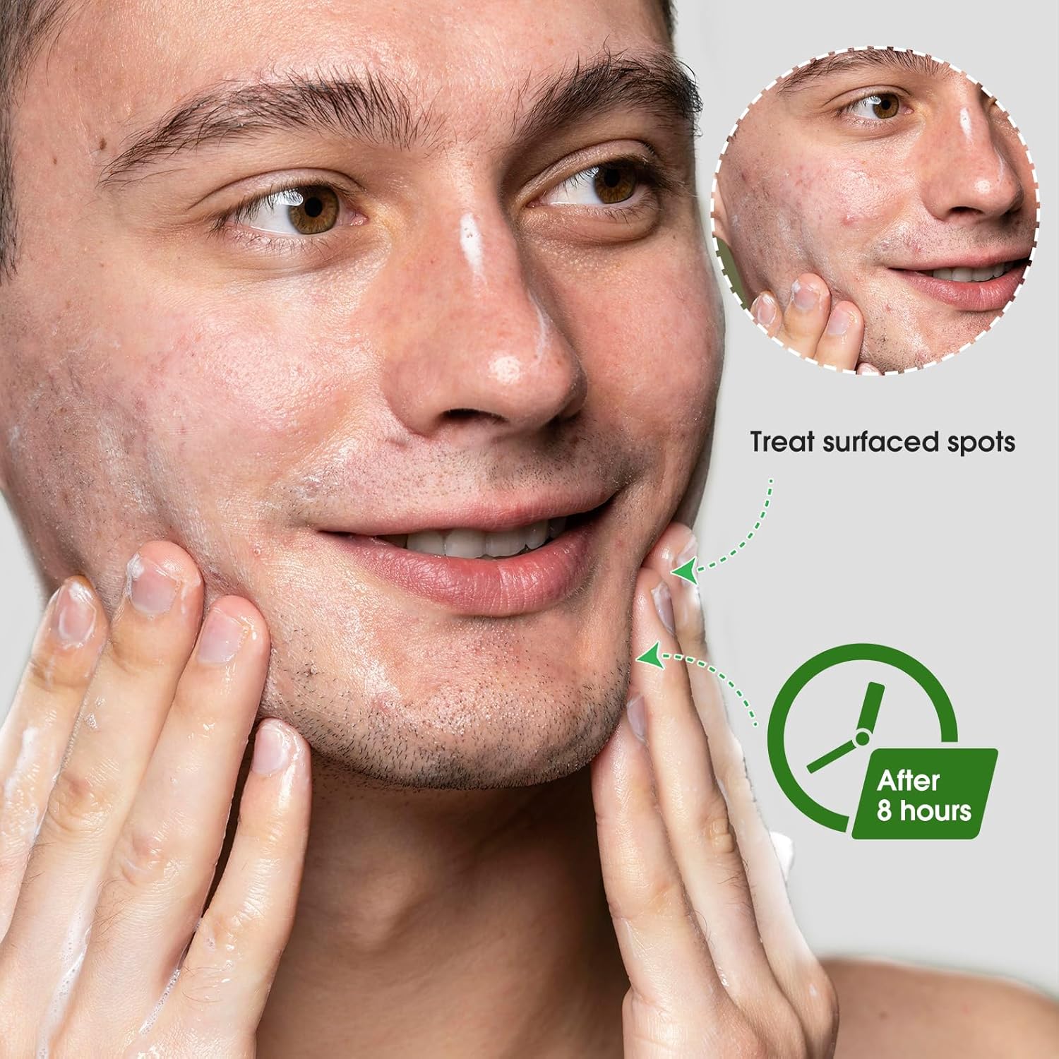 ACOTYE Pimple Patches Spot Patches - 35 Count (5 Pack) | Tea Tree Oil, Calendula, Salicylic Acid | Clear Acne Fast with Gentle, Soothing Formula | 4 Sizes for All Skin Types (BD01-5pack-uk, S) 7 81mE4m8bN0L. AC SL1500