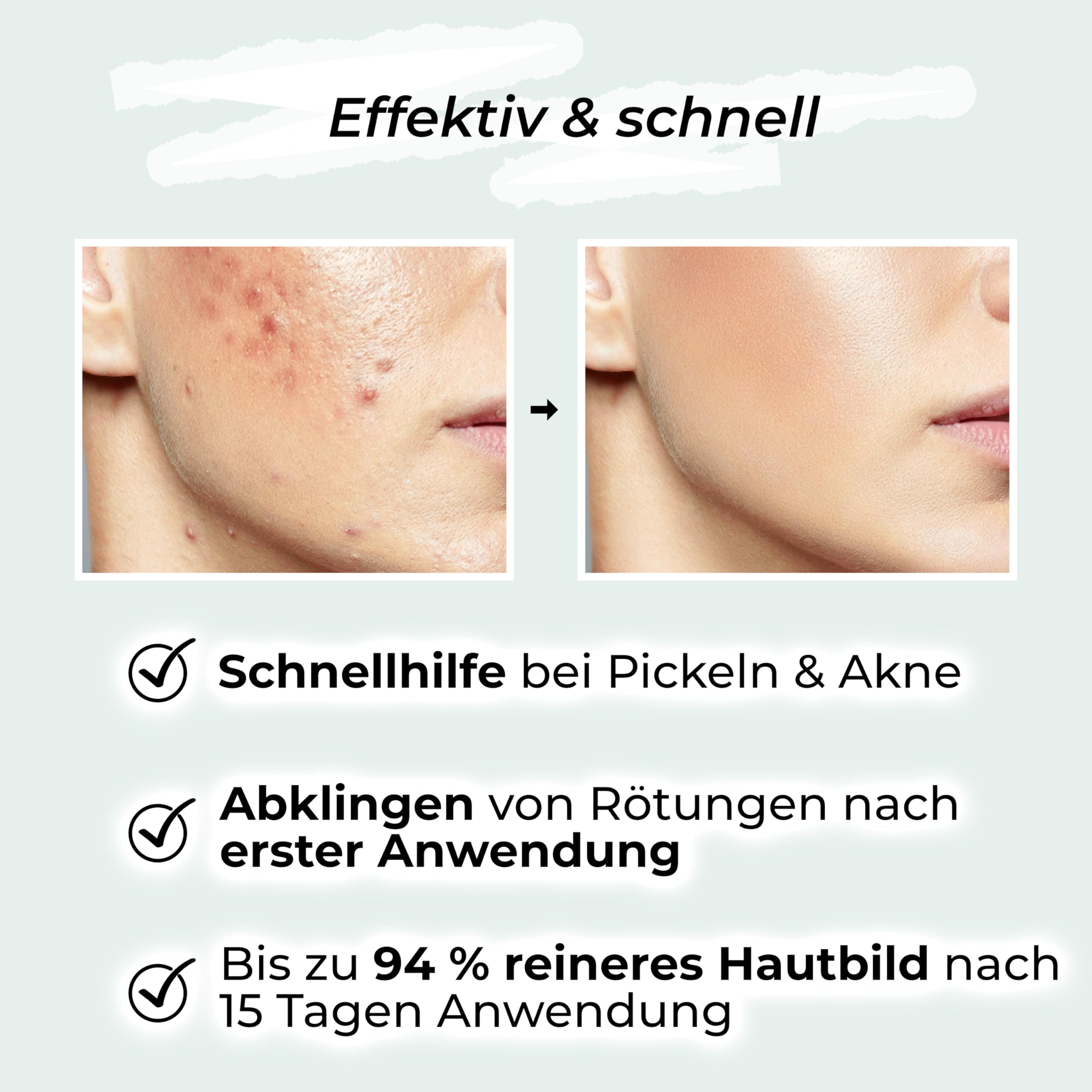 VIGOROUS® Zinksalbe gegen Pickel 60ml - Anti Pickel Creme auch für Pickel am Po und Rücken -mit Teebaumöl & Salicylsäure - SOS Zink Salbe gegen Mitesser und unreine Haut - Zugsalbe Pickel - Akne creme