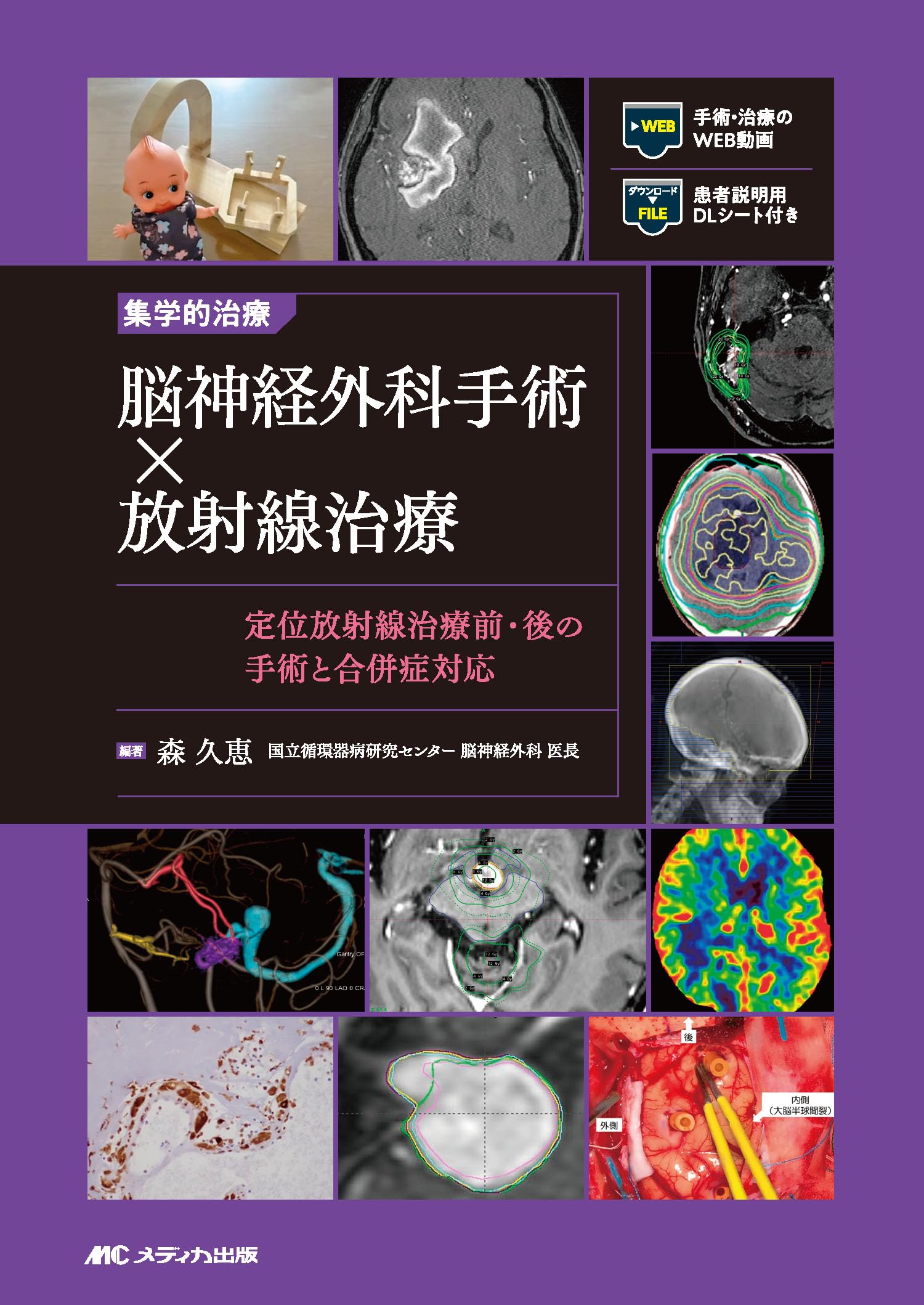 集学的治療 脳神経外科手術×放射線治療：定位放射線治療前・後の手術と