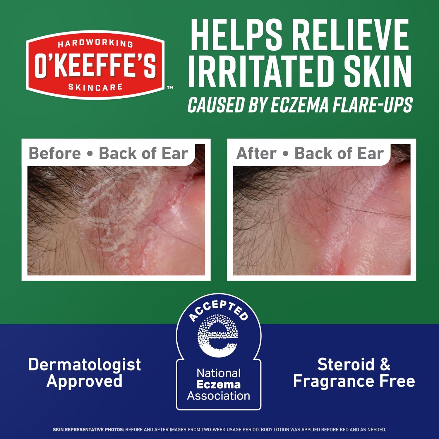 O’Keeffe’s Skin Repair Eczema Relief Body Cream, 7oz Tube (Pack of 1) – 48 Hour Itch Relief in One Use