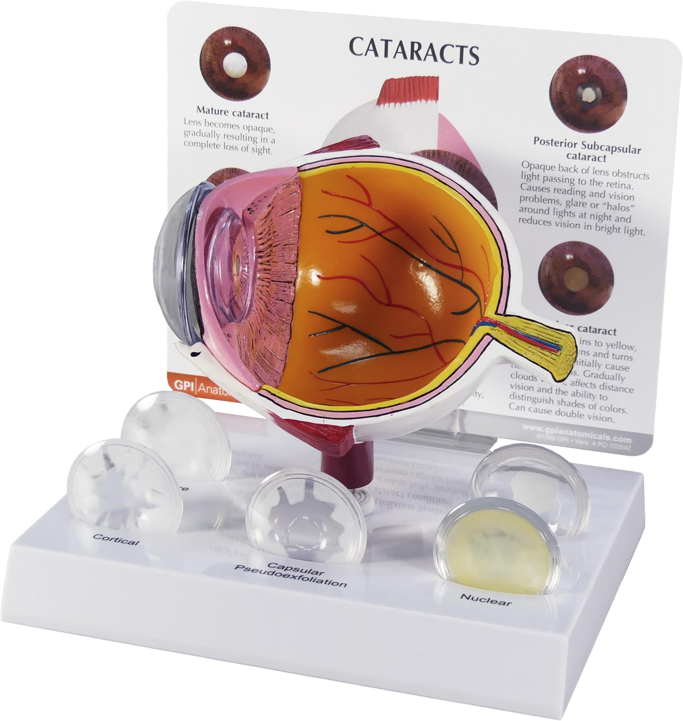 GPI Anatomicals - Cataract Eye Model, Replica of an Eye with Cataract Conditions for Human Anatomy, Physiology Education, Anatomy Model for Doctor's Office and Classrooms, Medical Learning Resources