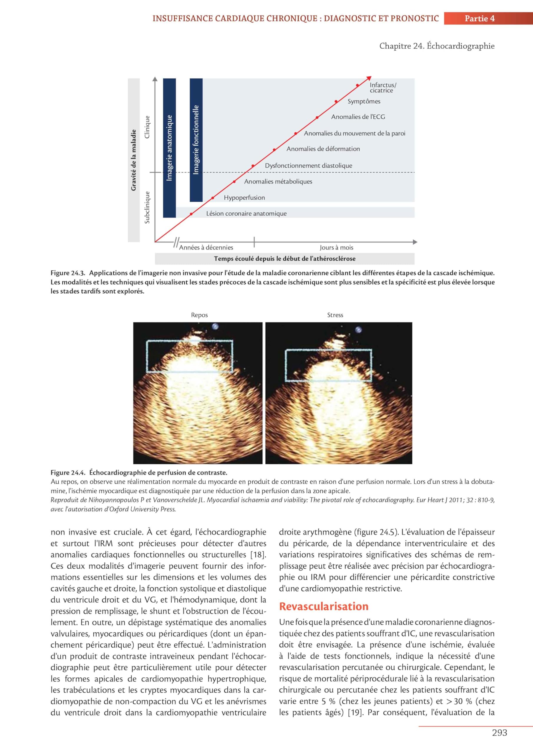 Insuffisance cardiaque