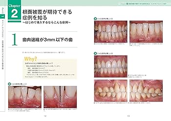 無理なくできる根面被覆導入マニュアル | 木村 英隆 |本 | 通販