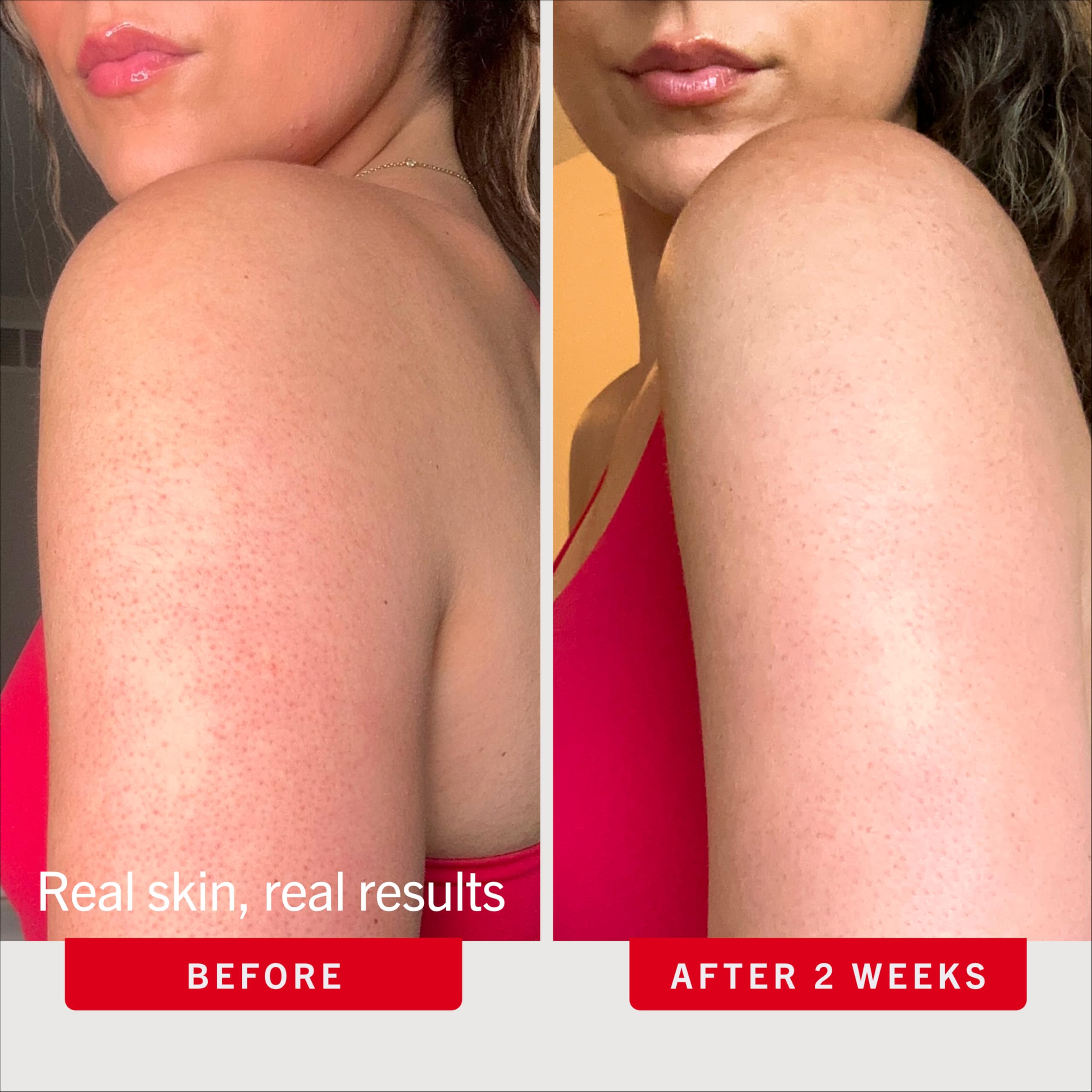 First Aid Beauty KP Bump Eraser Body Scrub, 10% AHA Keratosis Pilaris Exfoliator (Glycolic & Lactic Acid) – Treatment for Strawberry Legs, Razor Bumps & Rough Bumpy Skin, Safe for Sensitive Skin - 4