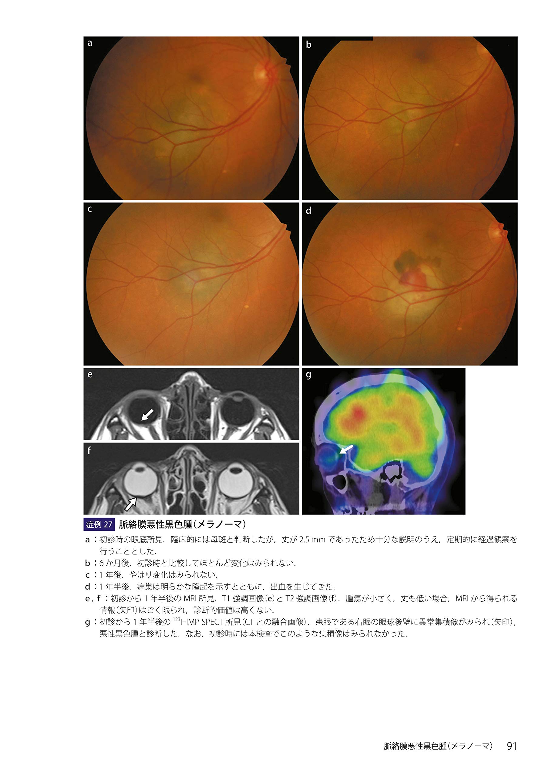 ☆セール 眼内腫瘍アトラス (新品) - 健康/医学