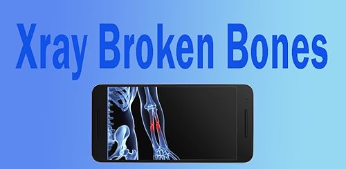 Broken Bones Xray