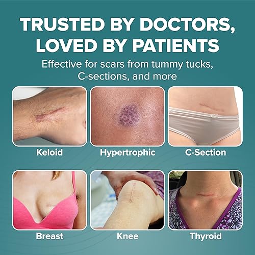 Miniatura 7 de Epi-Derm C-Strips, láminas de gel de silicona para cicatrices, ideal para cesáreas, abdominoplastia, histerectomía y cicatrices de cirugía cardíaca,