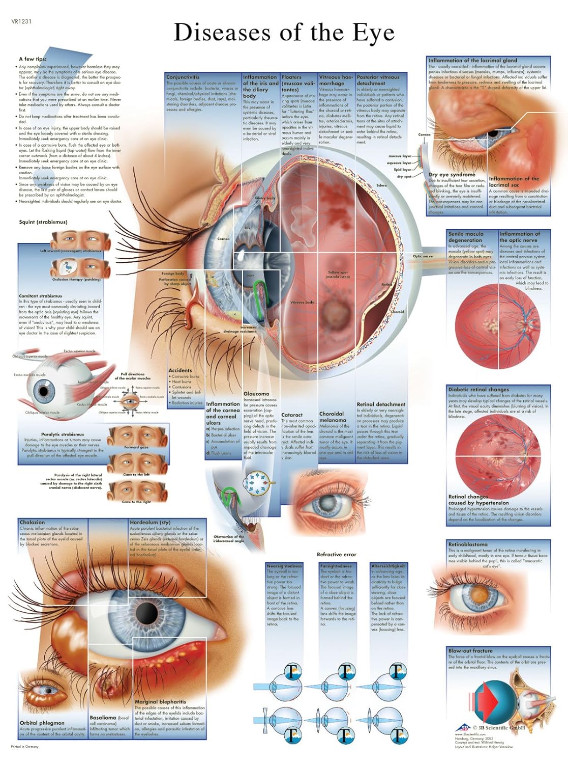 3B Scientific Human Anatomy - Diseases of The Eye Chart, Laminated Version, 1001498