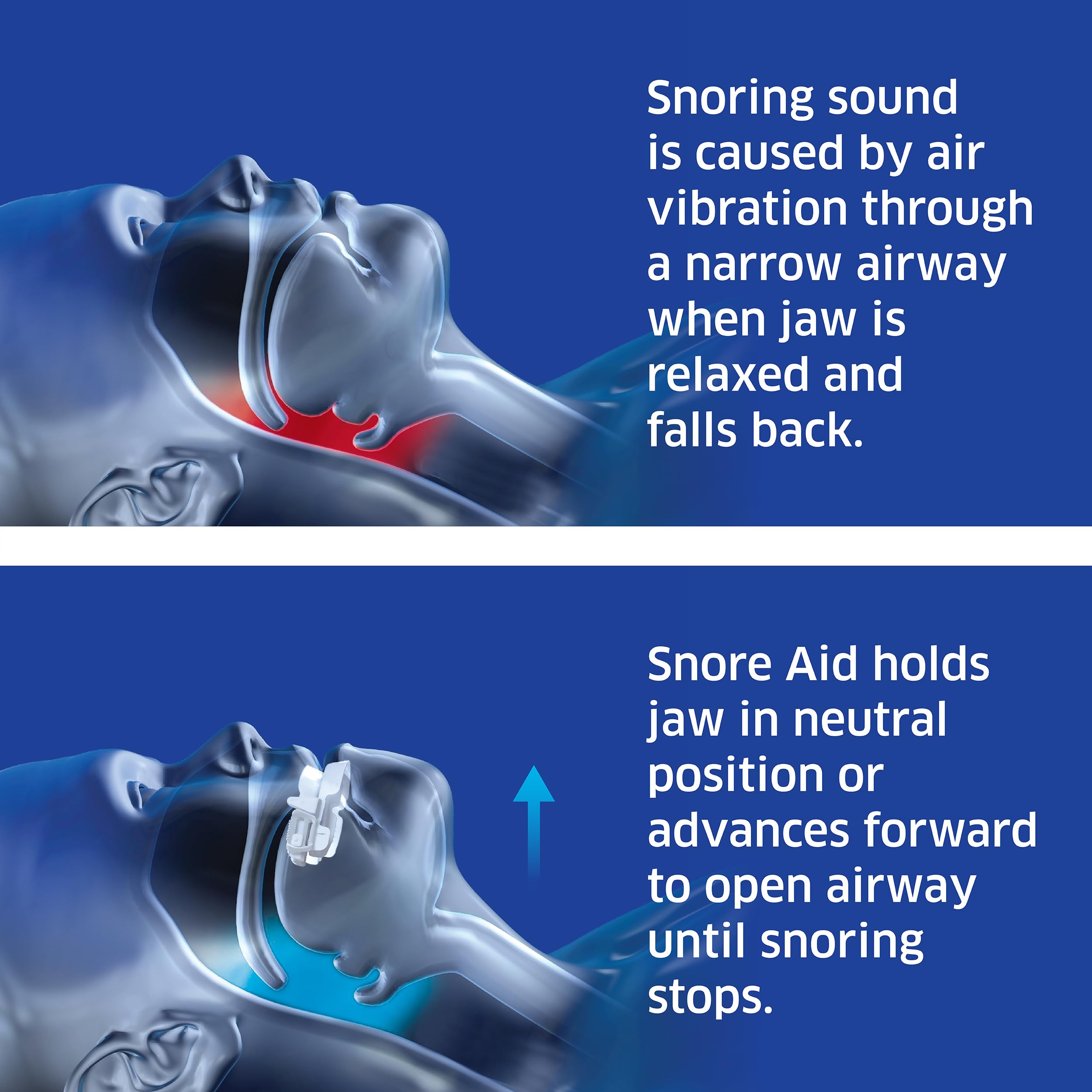 SleepRight Snore Aid Plus Nasal Breathe Aid - FDA Cleared for Snoring – Anti-Snoring Device – Snore Stopper for Men and Women - Effective Snore Reducing Aid that Works — Amazon image 3