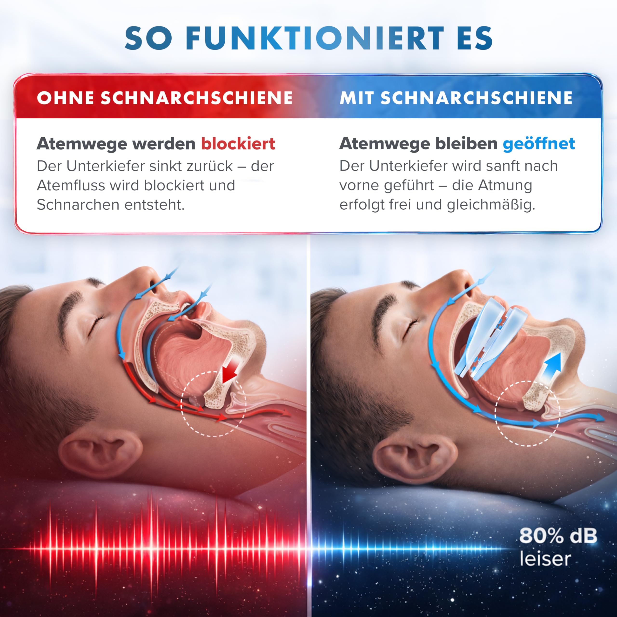 Schnarchschiene Anti-Snoring Mouth Guard ST11 gegen Schnarchen und Knirschen
