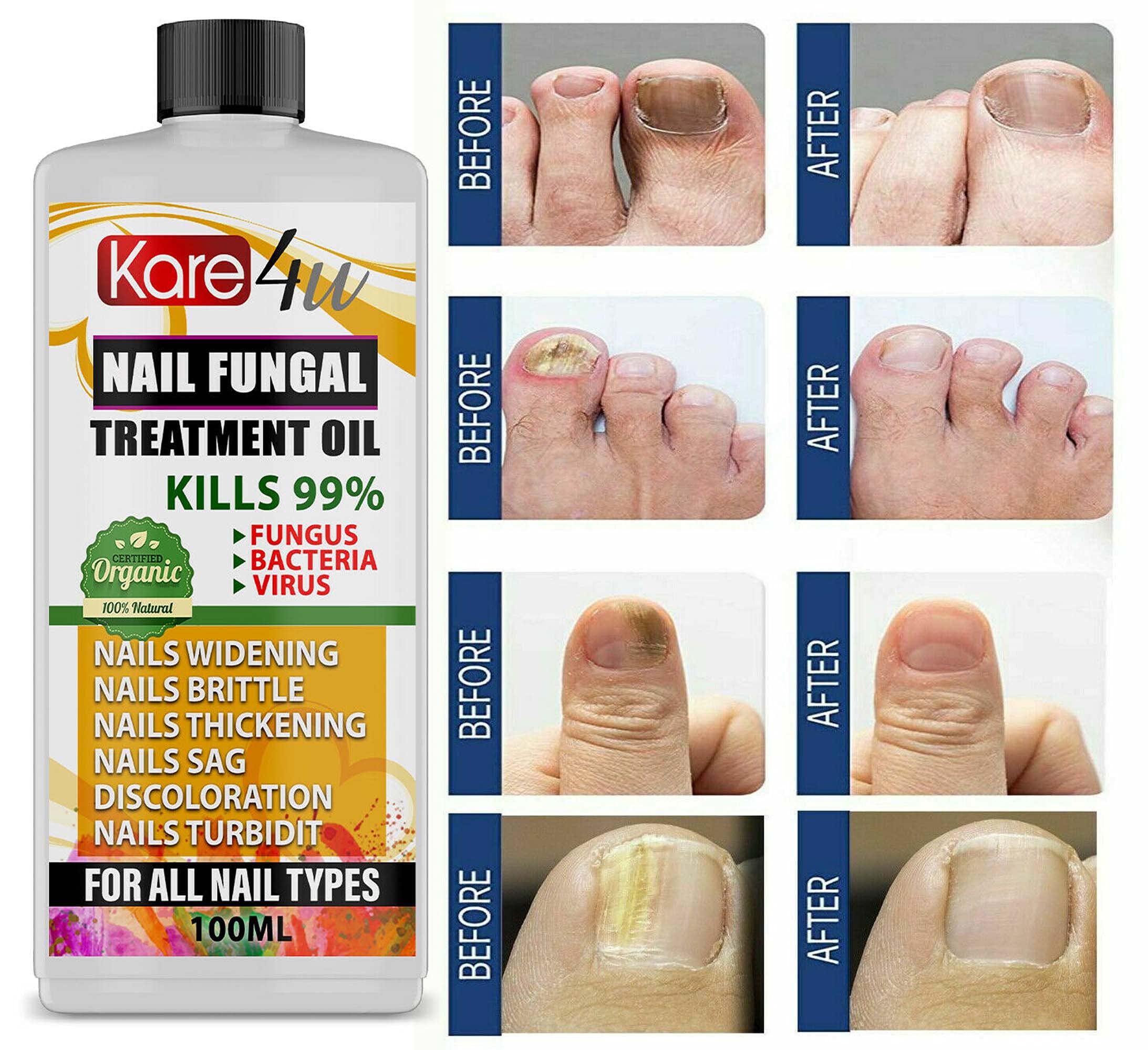 Top more than 147 best fungal nail treatment australia latest
