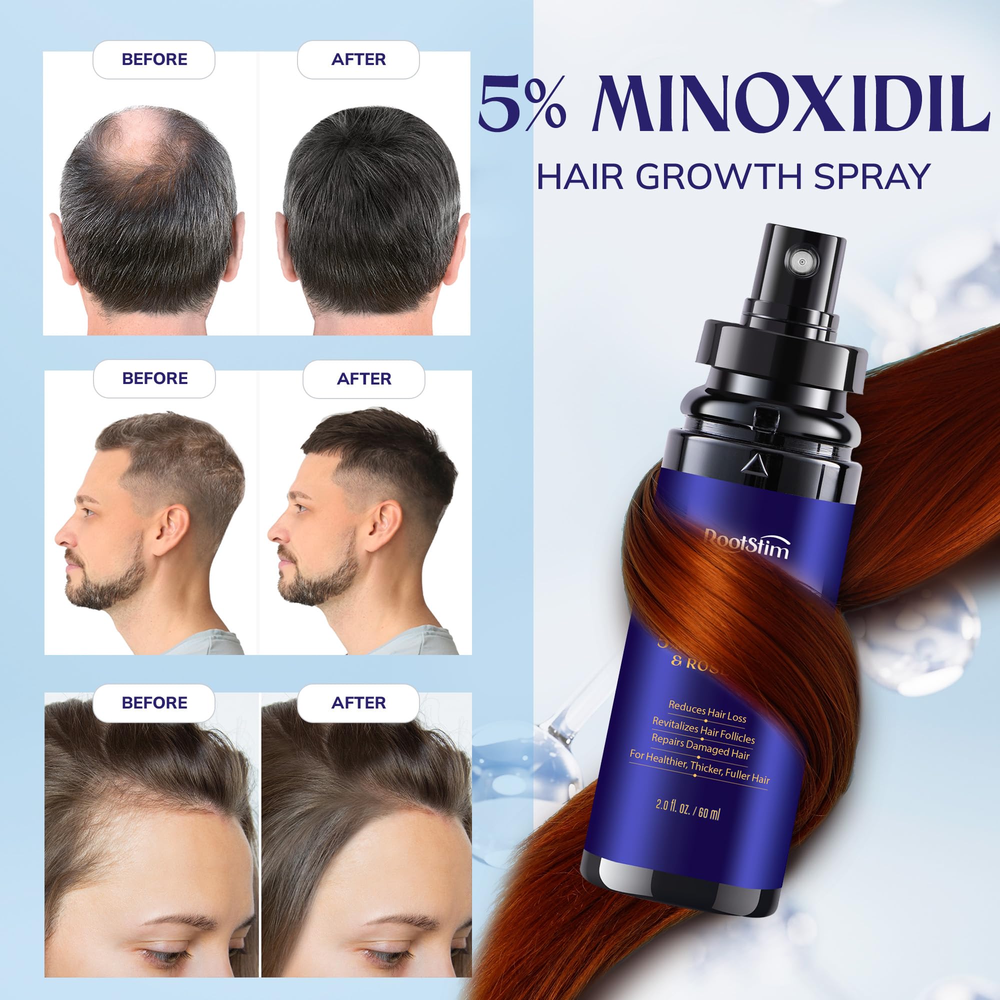 RootStim 5% Minoxidil Hair Regrowth Treatment with Rosemary, 3-Pack