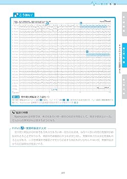 【 稀少 】てんかん発作時脳波アトラス 1987年発行 アトラスてんかんの発作間欠期・発作時脳波を読む | 高橋 幸利