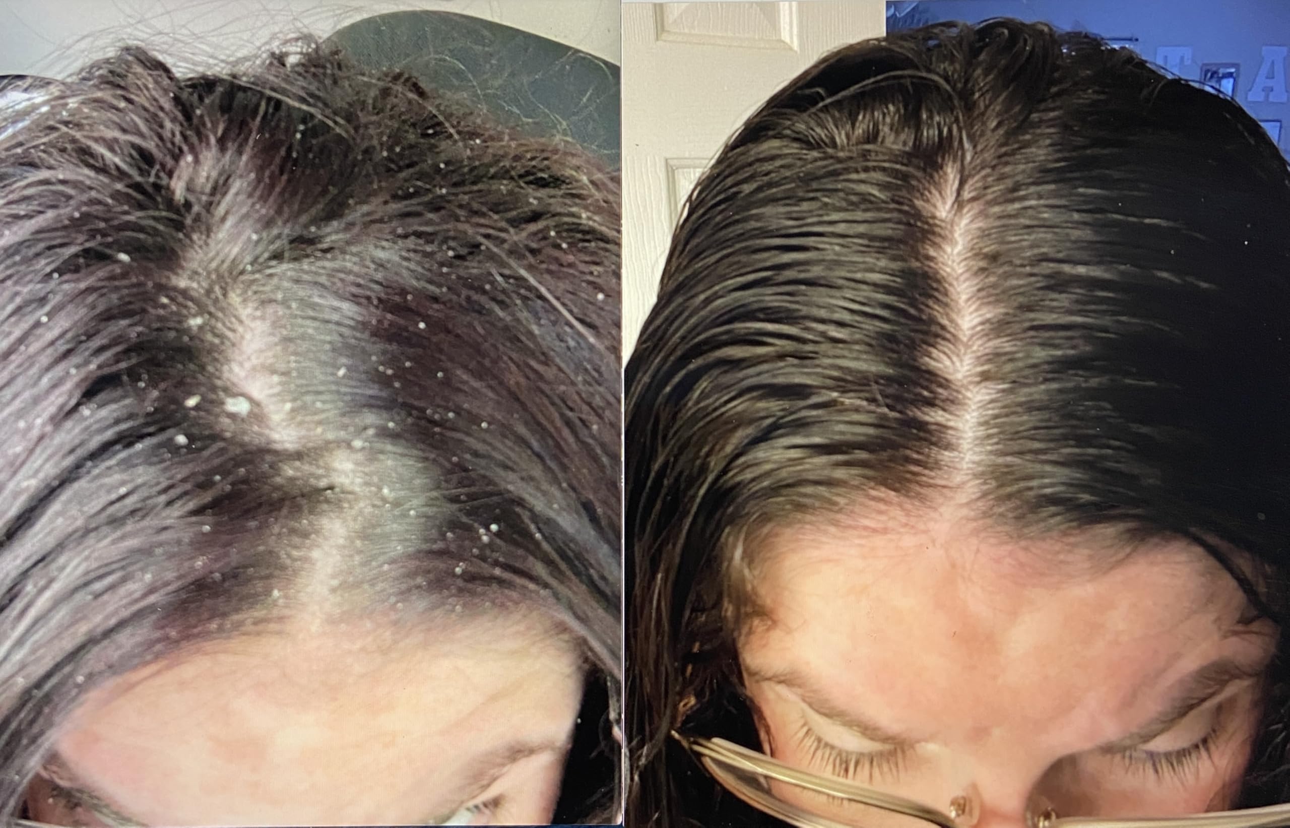 PHYTOMRX Dander-Zyme Dandruff Treatment, 1.7 fl oz