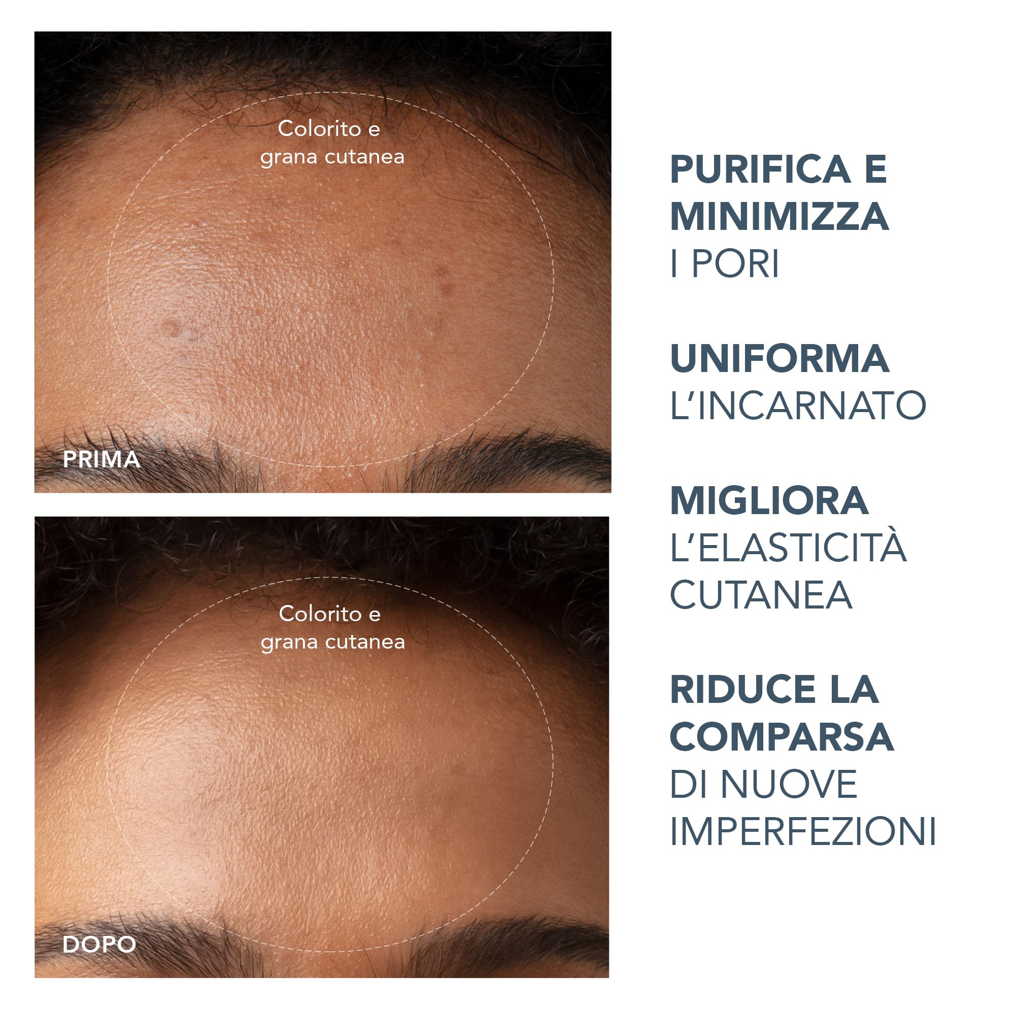 Set FOREO Blackheads Suck KIWI - Aspira punti neri professionale per punti bianchi e punti neri + Detergente viso LUNA Micro-Foam Cleanser 2.0 (100 ml) - Estrattore di impurità per viso e naso