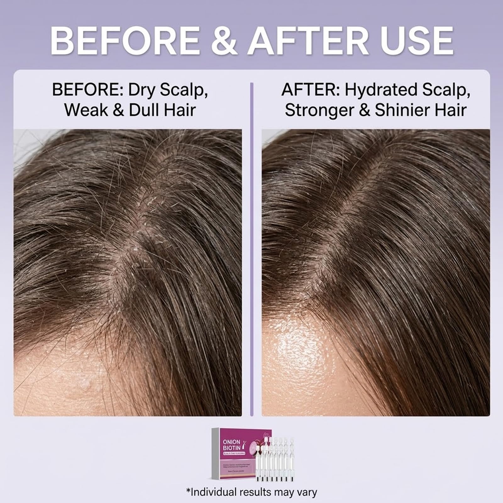 Red Onion Biotin Scalp Serum do wzrostu i grubości włosów, 20 szt., jednorazowe sterylne ampułki, cebula, biotyna, esencja do wzmocnienia, odżywcza, do codziennej pielęgnacji włosów (5B)
