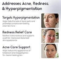 Vista 3 de Crema para el acné de ácido azelaico 15 para la cara, alivio del enrojecimiento, tratamiento de rosácea para la cara, alivia el acné