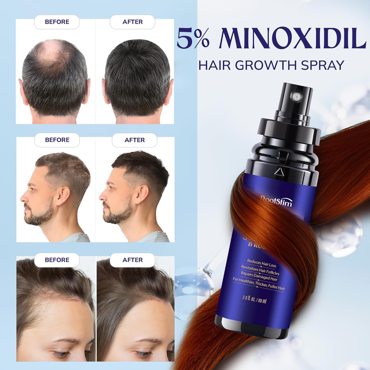 5% Minoxidil Hair Growth for Men and Women: 2-Pack Extra Strength Minoxidil Hair Loss Treatment Serum with Rosemary for Faster Stronger Thicker Hair Growth - 60ML Each