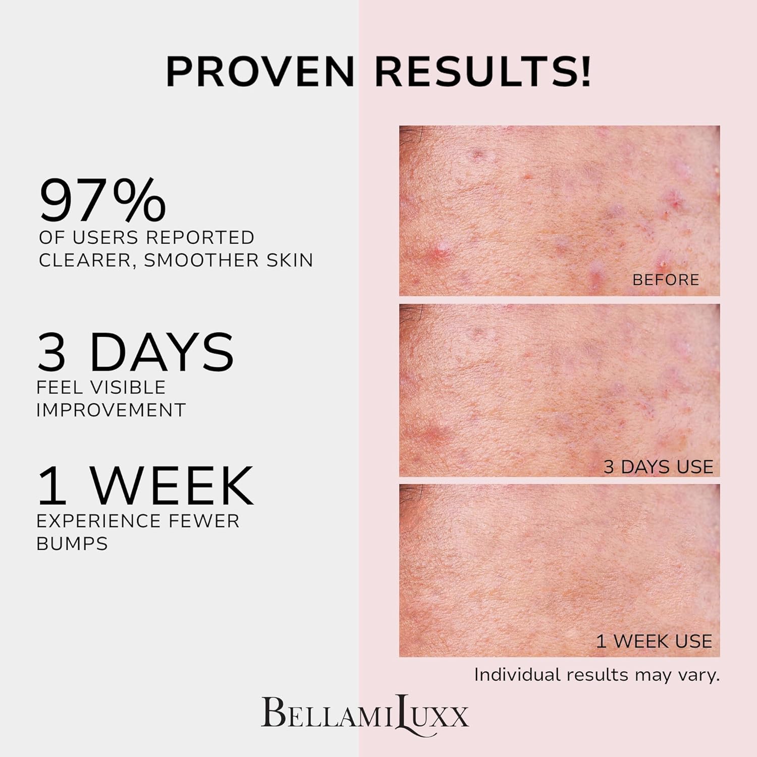 Butt Acne Treatment Set: Acne Soap Bar + Butt Treatment Lotion for Breakouts on Buttocks, Thighs, Back, Chest & Ingrown-Prone & Folliculitis-Prone Skin – Helps Reduce Body Breakouts