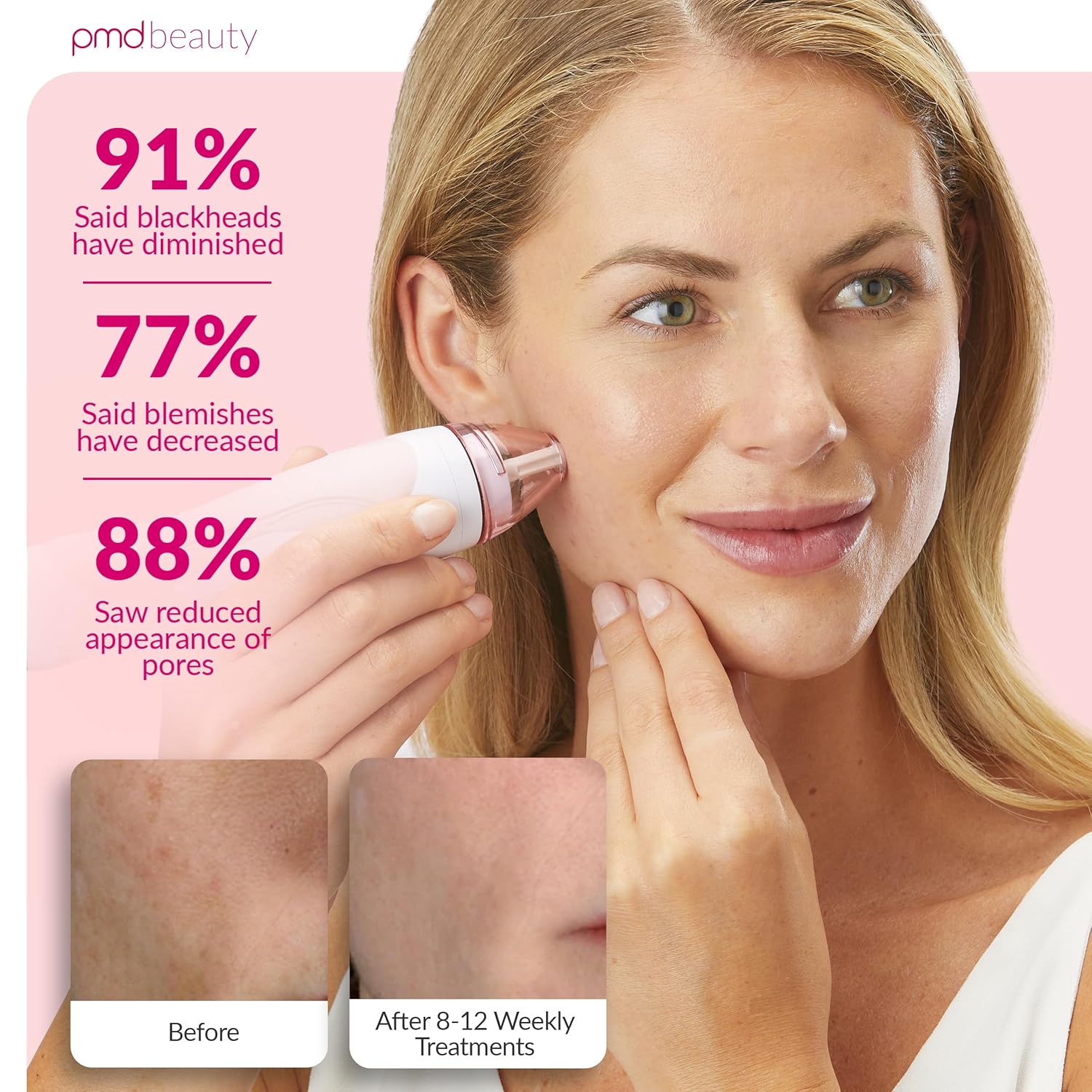 PMD Beauty Personal Microderm Pro - At-Home Use, Facial Exfoliator Tool, Microdermabrasion Machine Kit for Face and Body Skincare - Image 4