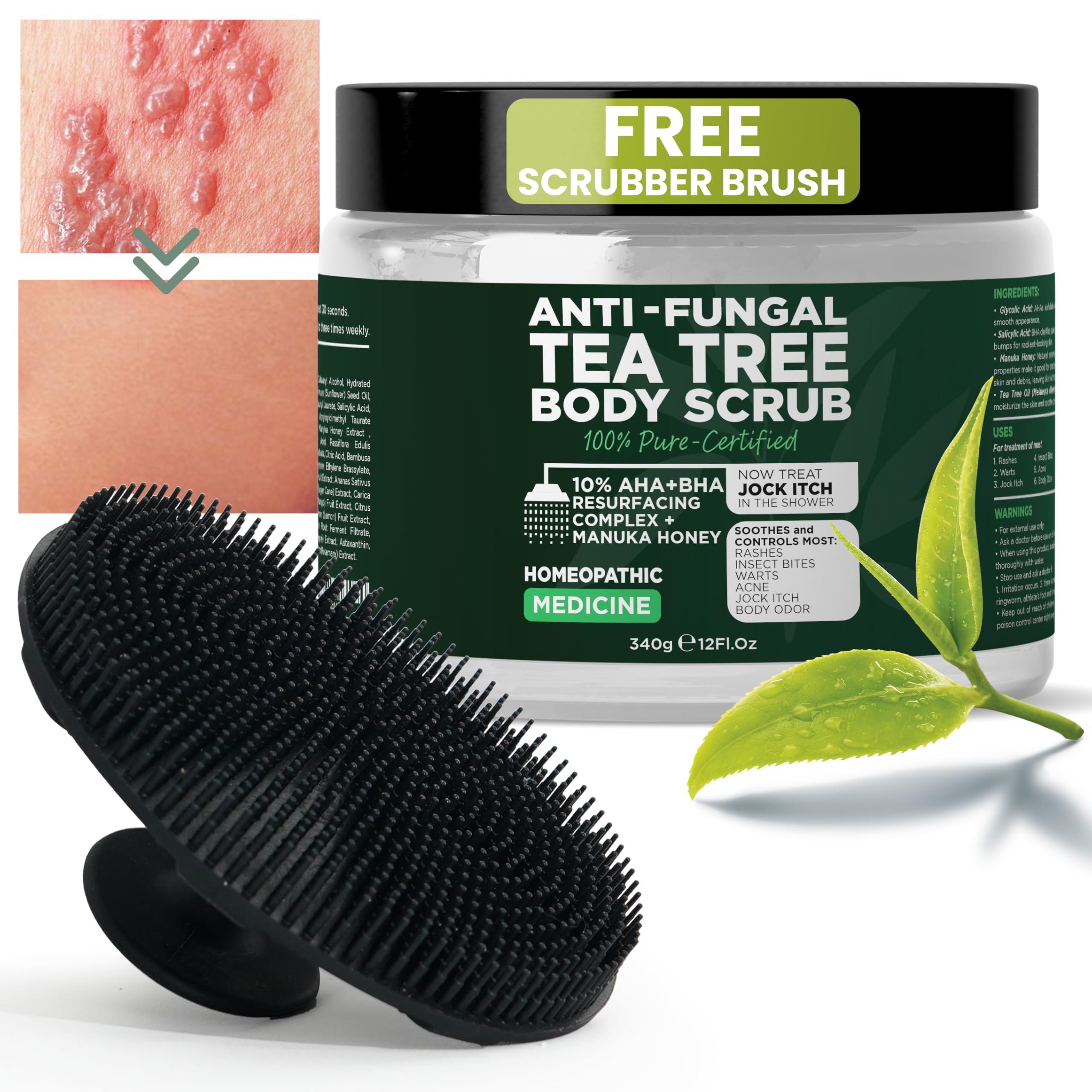 Antifungal Body Scrub with Tea Tree Oil – Exfoliating Body Wash for Women & Men – Soothes Itchy Skin, Rashes, Acne, Warts & Insects Bites – 12 Fl oz with Scrubber Brush