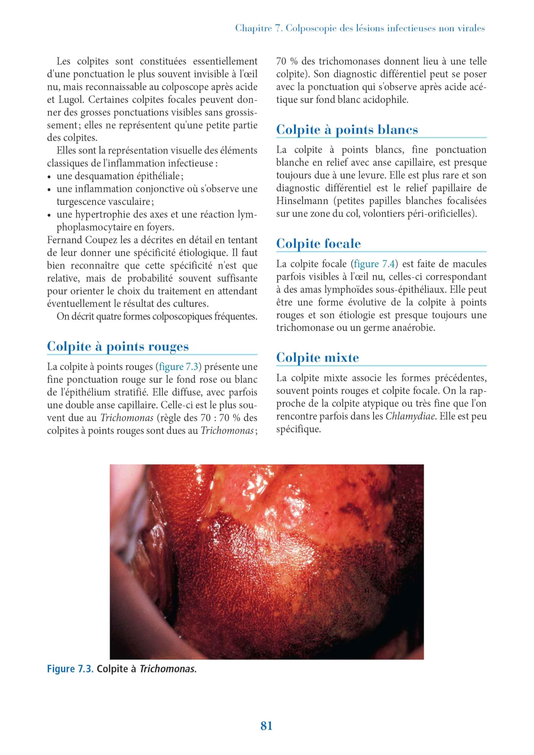 La colposcopie: Techniques et diagnostics