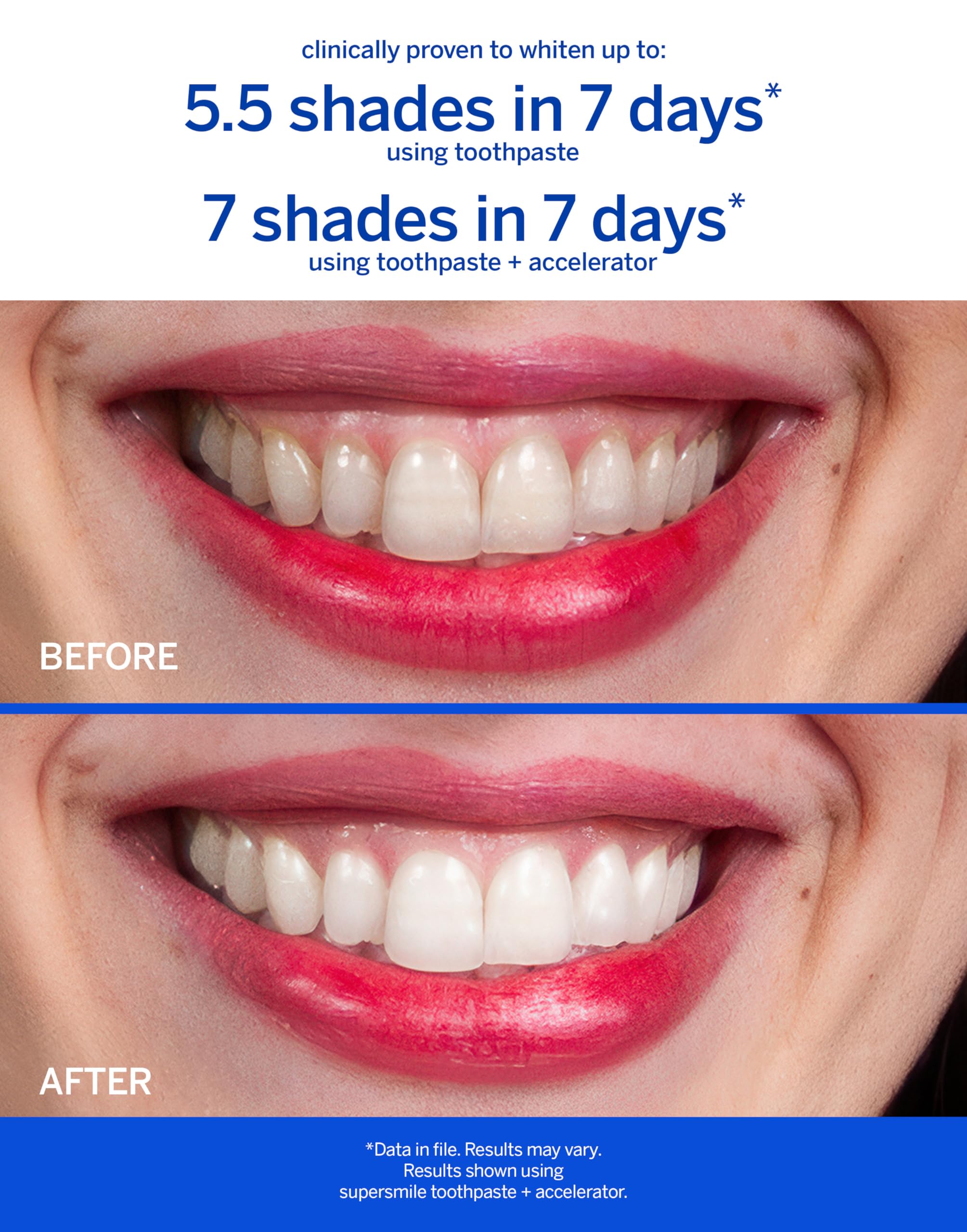 Supersmile Fluoride-Free Whitening System – 3.4 oz Professional Grade Whitening Toothpaste & 3.6 oz Accelerator – Whitens up to 6 Shades & Strengthens Enamel