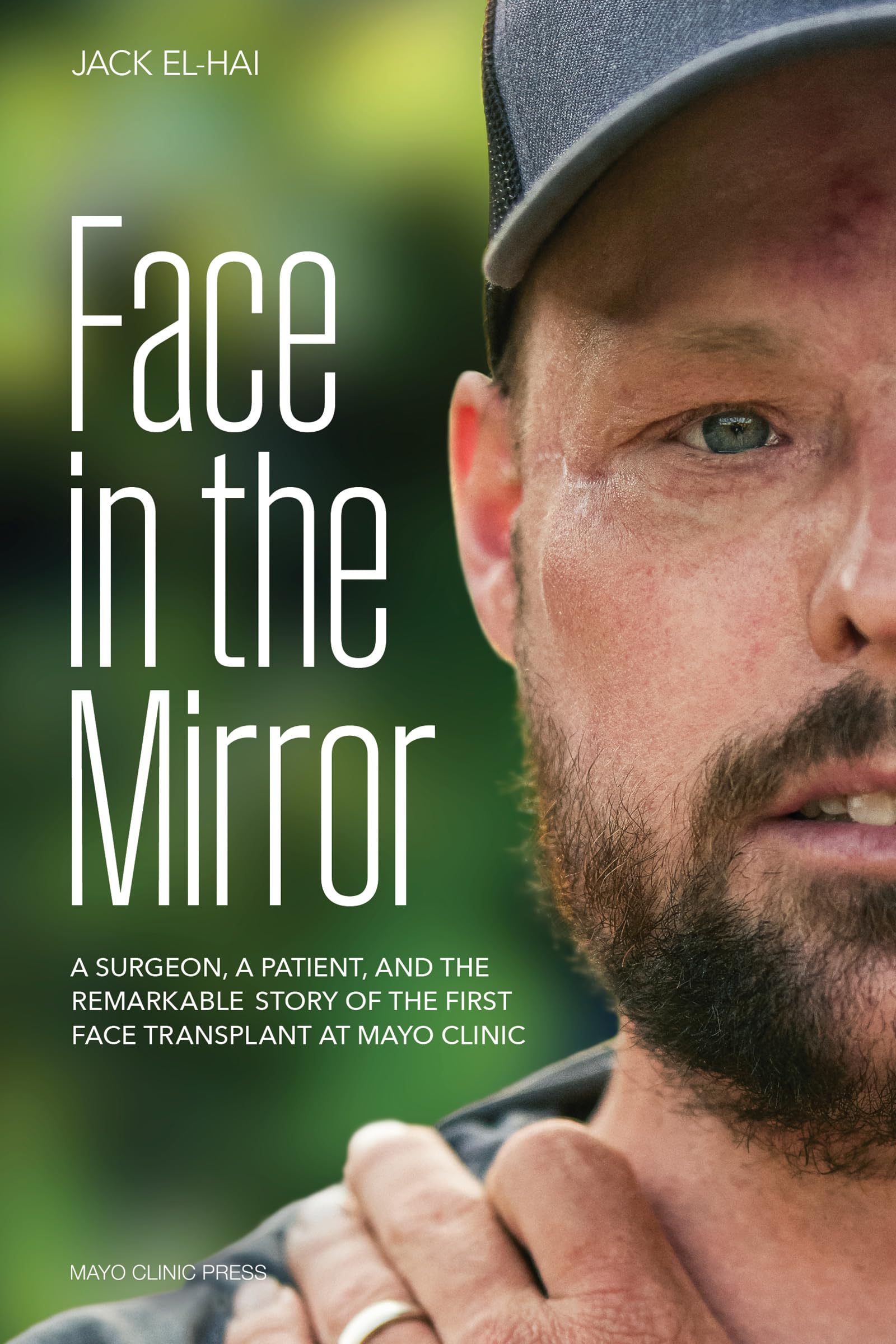 Face Transplant : How Medical Science Gave a Man a New Face and Restored His True Identity