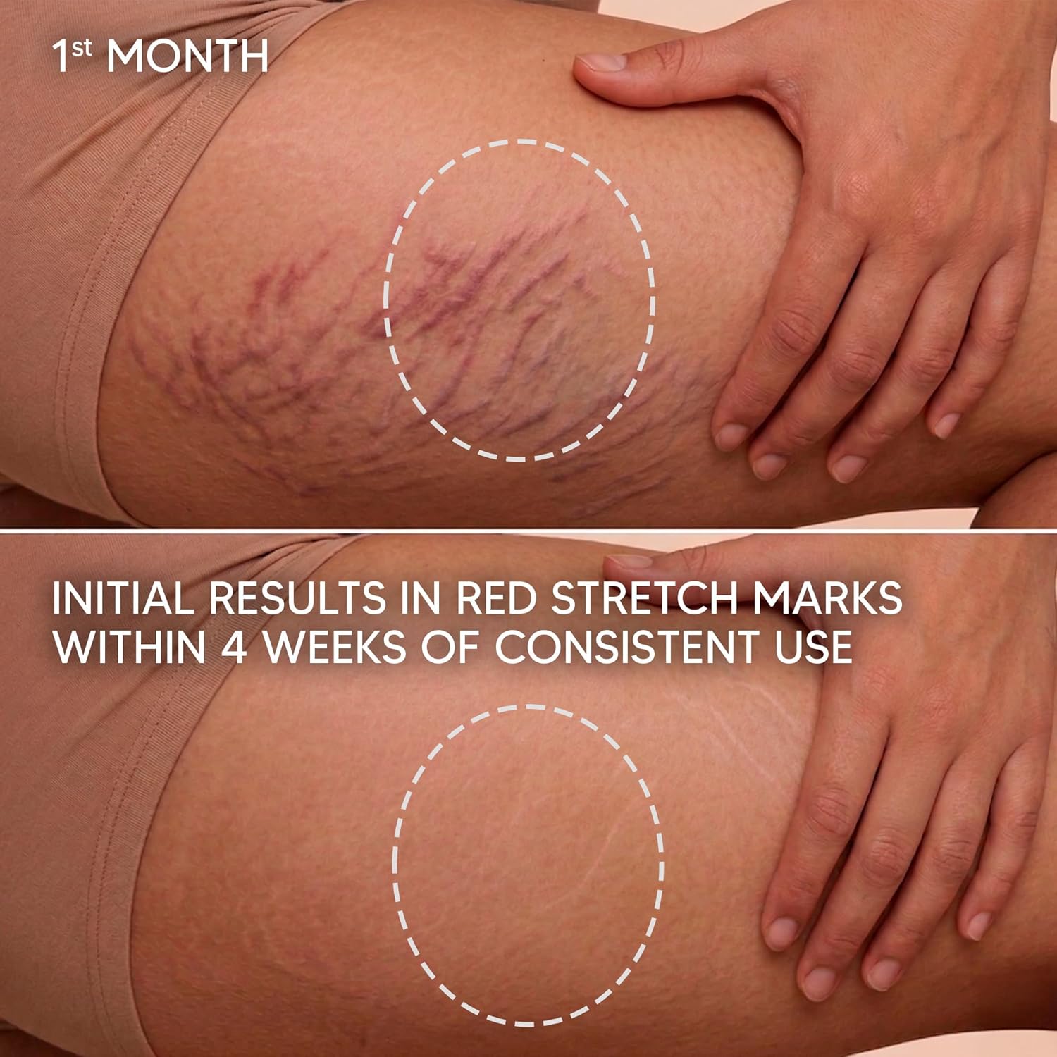 Cicatrissim Red Stretch Mark Cream for Red and Purple Striae - Softens Stretch Marks, Evens Skin Tone, and Firms Skin - All Skin Types - 150g