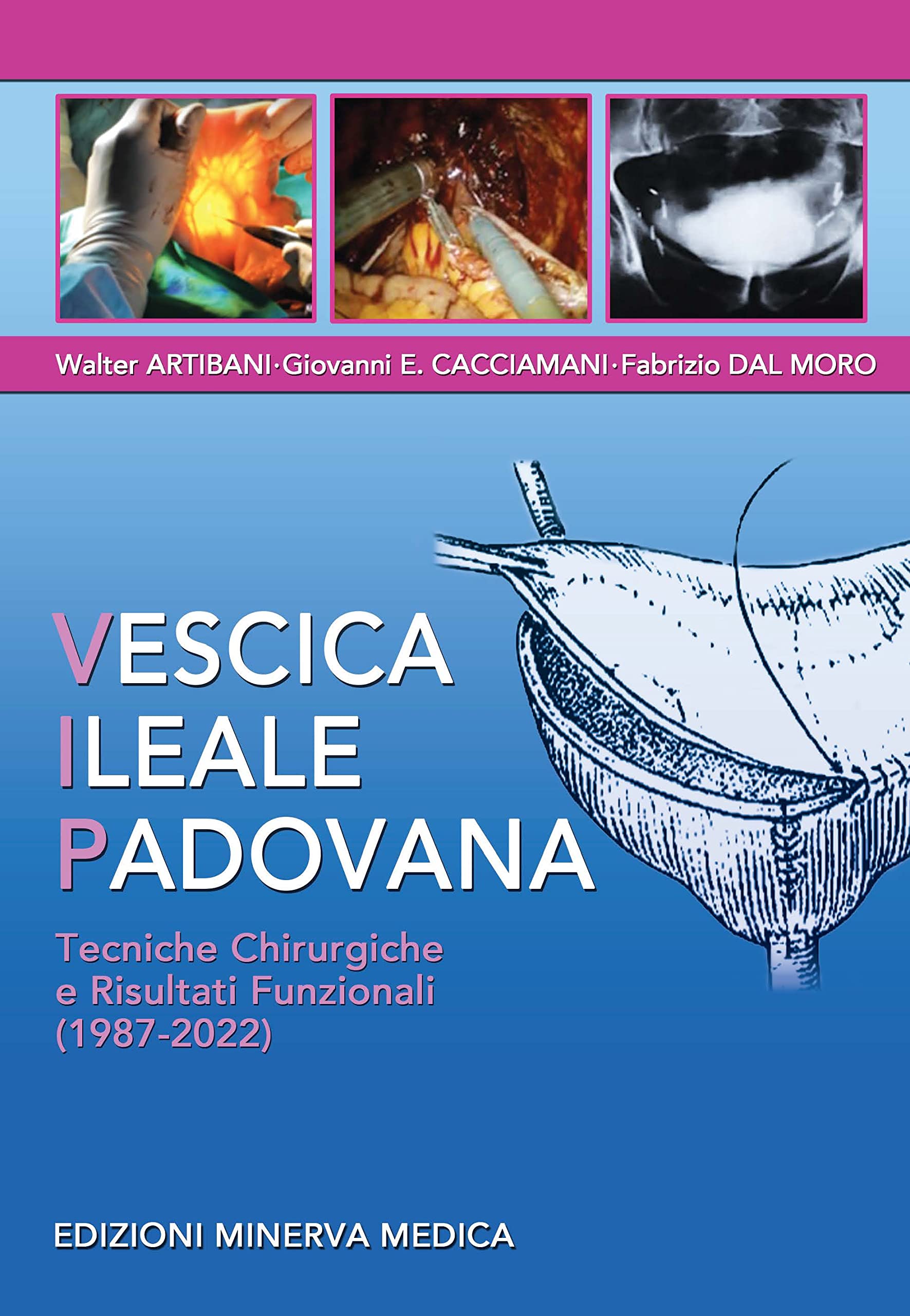 Minerva Vescica Ileale Padovana. Tecniche Chirurgiche E Risultati Funzionali (1987-2022) - 4