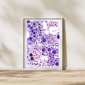 MEDPAPERS ITP Idiopathic Thrombocytopenia Bone Marrow Aspirate Hematology and Hematopathology Office Wall Art, Pathologist Hematologist Gift, Giclee (5x7 in)