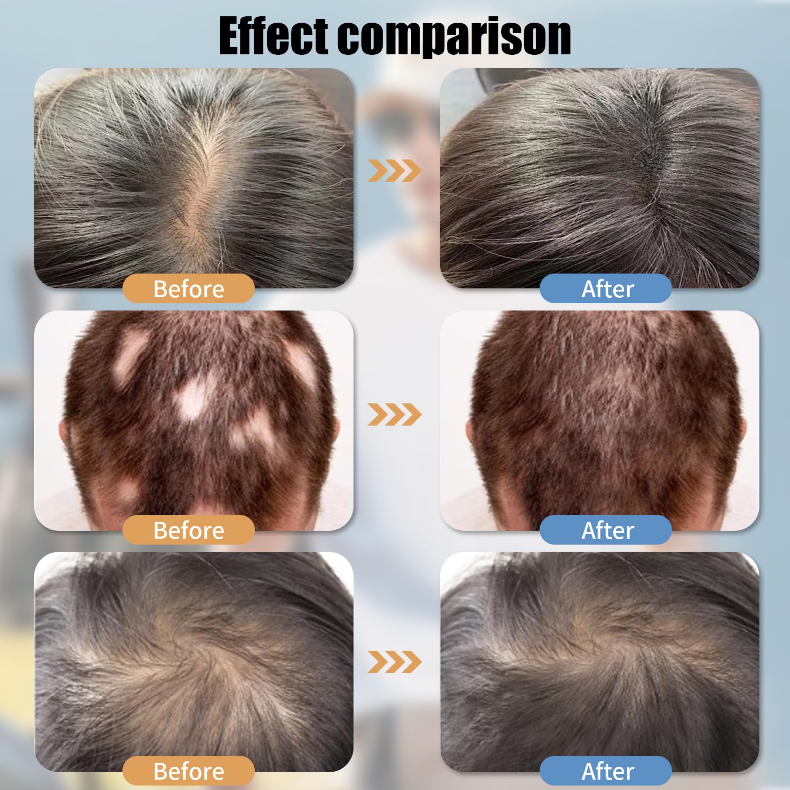 Rotlicht Haarwachstumskappe, Haarwachstum Cap,Rotlichtlampe Haare Anti-Haarausfall, 4 Modi, 470nm 630nm and 650nm Wavelength,Abnehmbarem Rotlicht Panel, 70 LEDs, Hair Growth Cap für Männer/Frauen