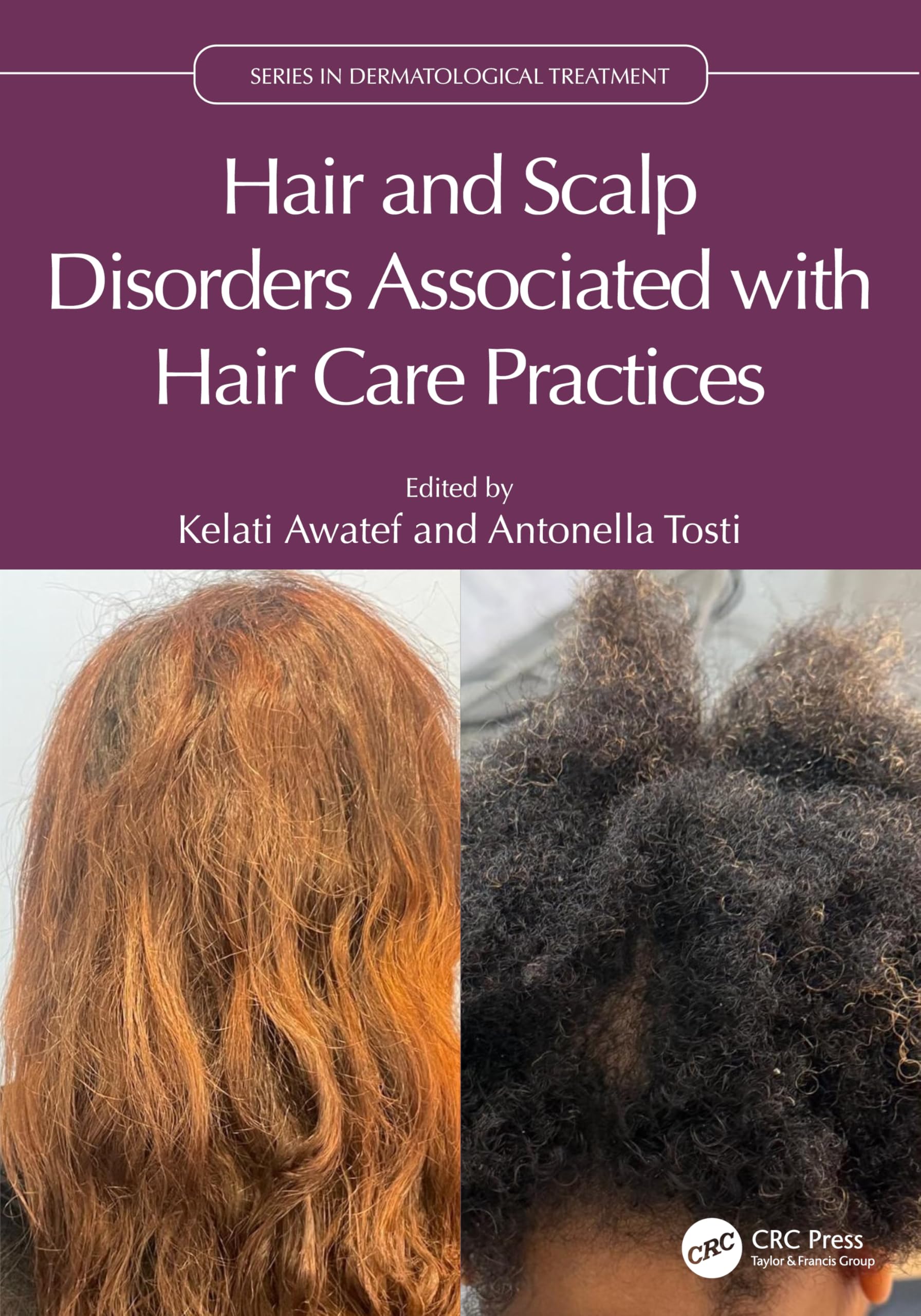 Hair and Scalp Disorders Associated with Hair Care Practices (Series in Dermatological Treatment)