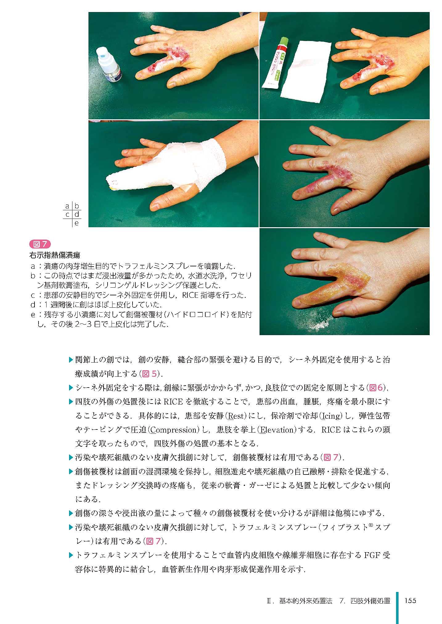 こうごうせい外傷 | 咬合性外傷 画像 – MUWDNE