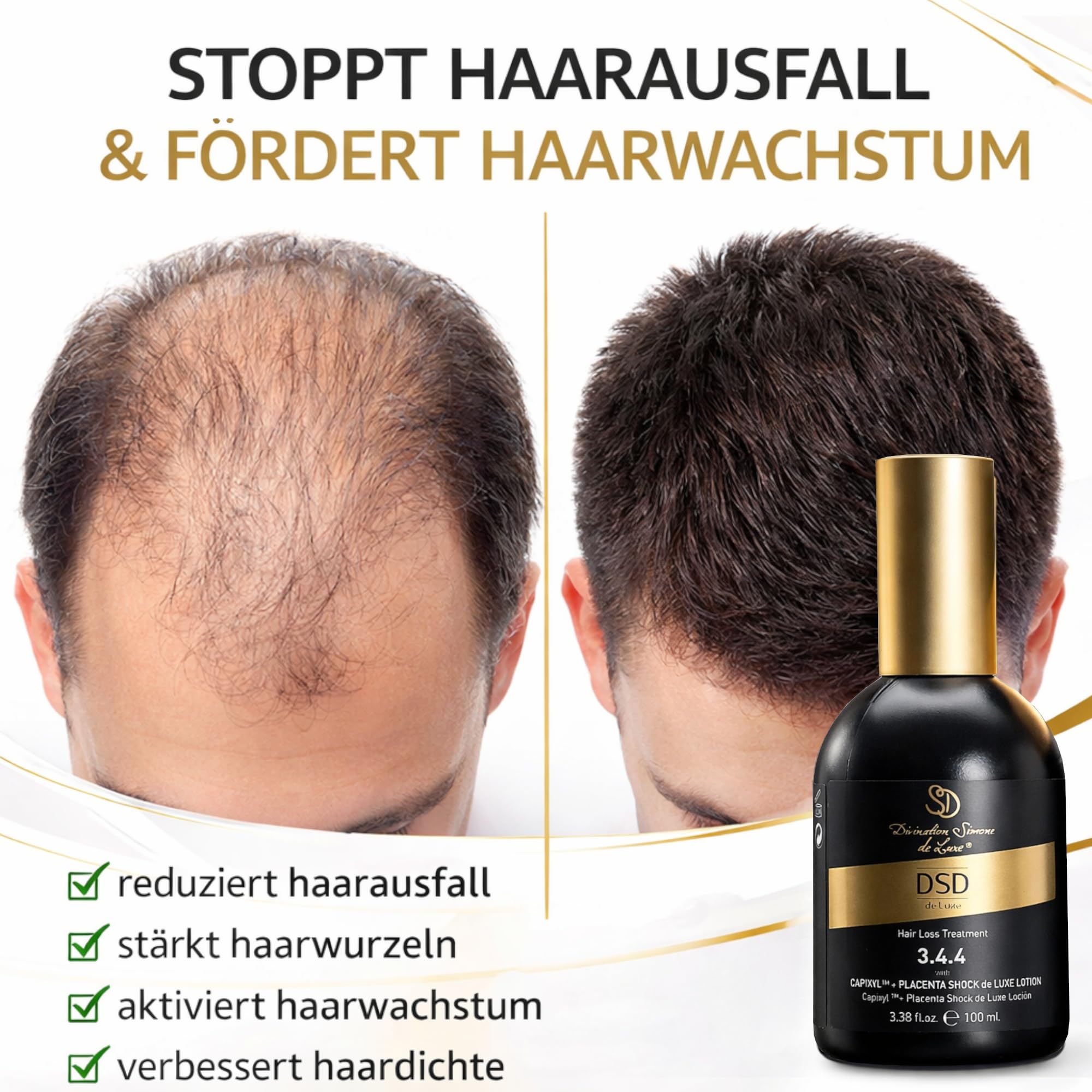 DSD de Luxe 3.4.4 Capixyl + Placenta Shock Lotion 100ml – Haarwachstum Serum gegen Haarausfall mit Acetyl Tetrapeptide-3, Rotklee Extrakt, Biochanin A, Keratin, Niacinamide – Kopfhaut Treatment