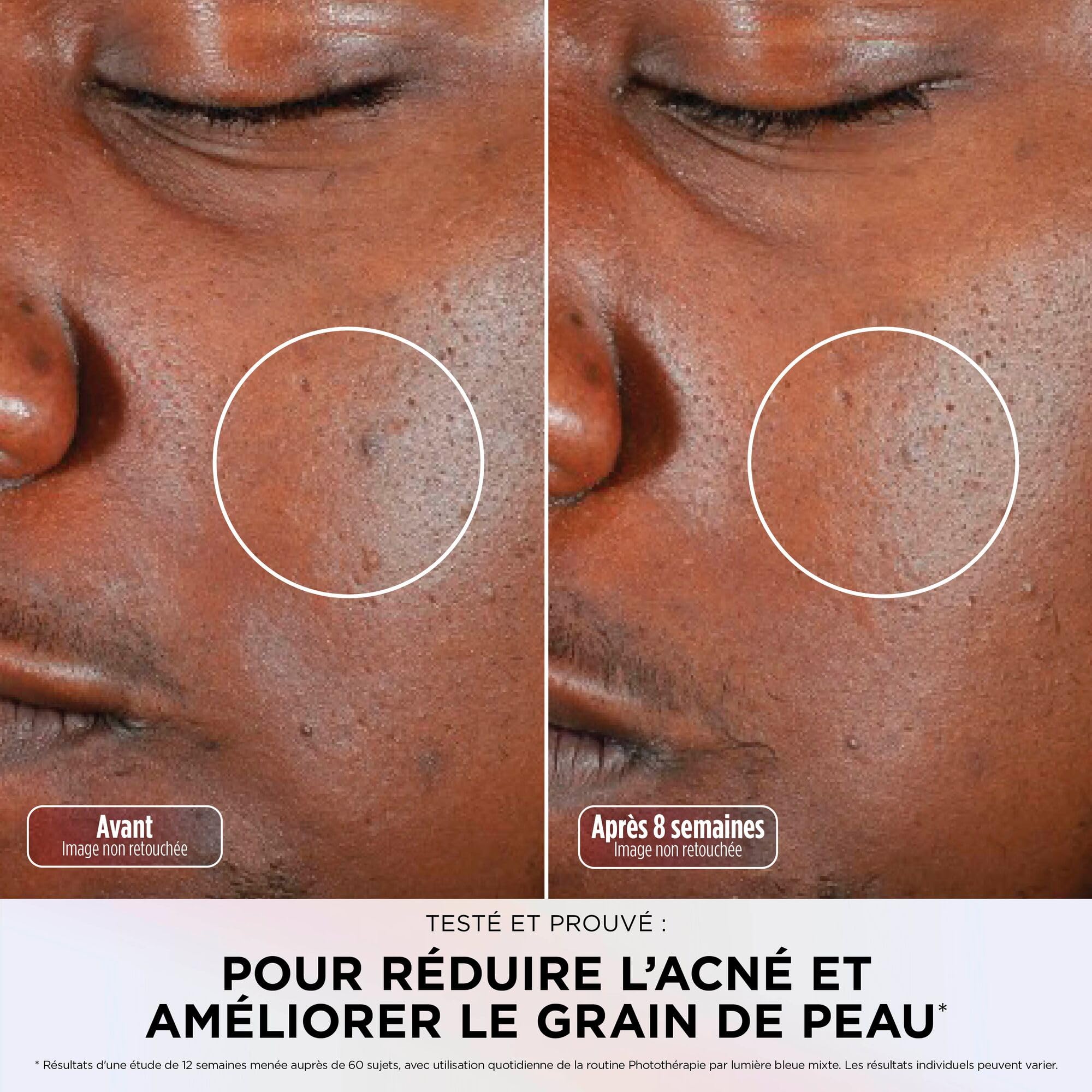 Masque LED Shark CryoGlow avec rafraîchissement du contour des yeux, LED rouge et bleue, Photothérapie par lumière infrarouge, USB-C, Télécommande + Stand de recharge du masque - Lilas XSKACS300EUPL