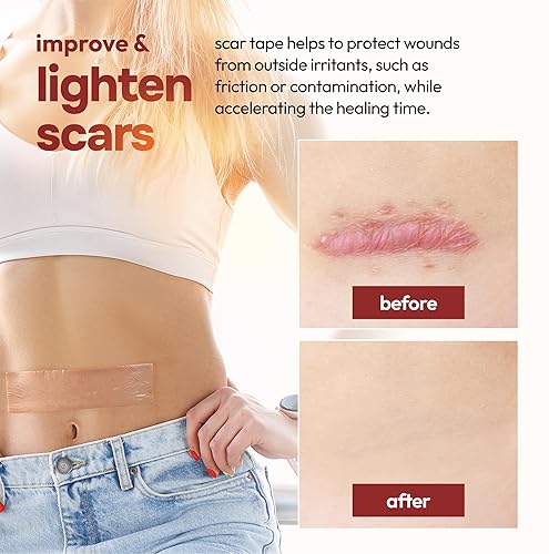 Miniatura 4 de AllSett Health Hojas de silicona para cicatrices, poscirugía, abdominoplastia, recuperación de cesárea, eliminación de golpes queloides, eliminación