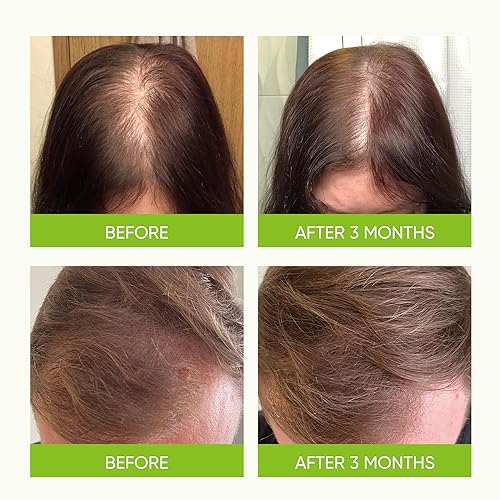 Miniatura 4 de Svvimer Sérum en Spray para el Crecimiento del Cabello - con Aceite de Batana de Romero y Biotina para la Pérdida y Adelgazamiento del Cabello - Más