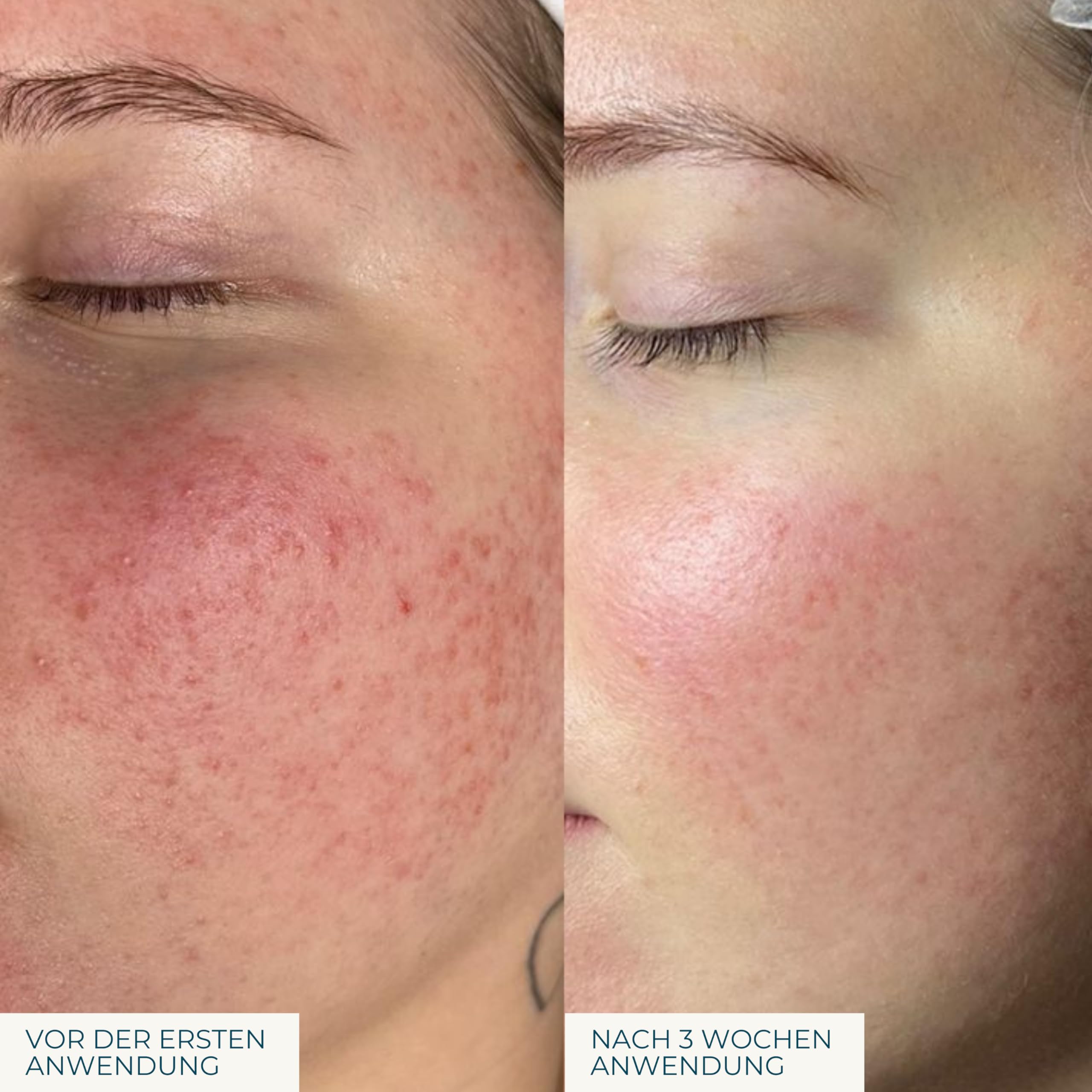 Skin Repair Feuchtigkeitscreme mit Aloe Vera, Hyaluron & Edelweiss - vegane Gesichtscreme für trockene Haut