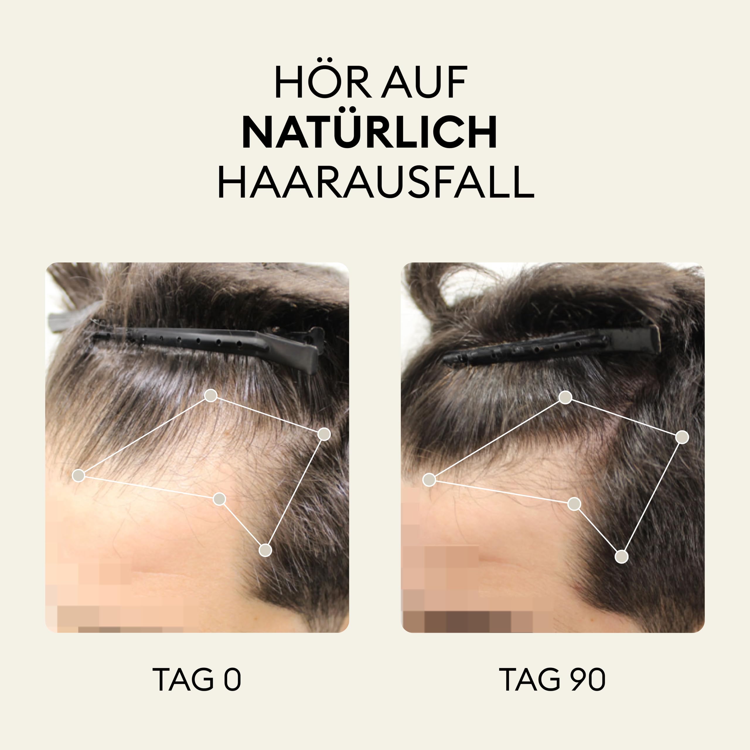 OMA & ME 3-in-1 - Serum gegen Haarausfall und zur Förderung des Haarwachstums - Fördert das Wachstum und reduziert den Haarausfall - 12 Ampullen à 6 ml (1 Monat Kur)