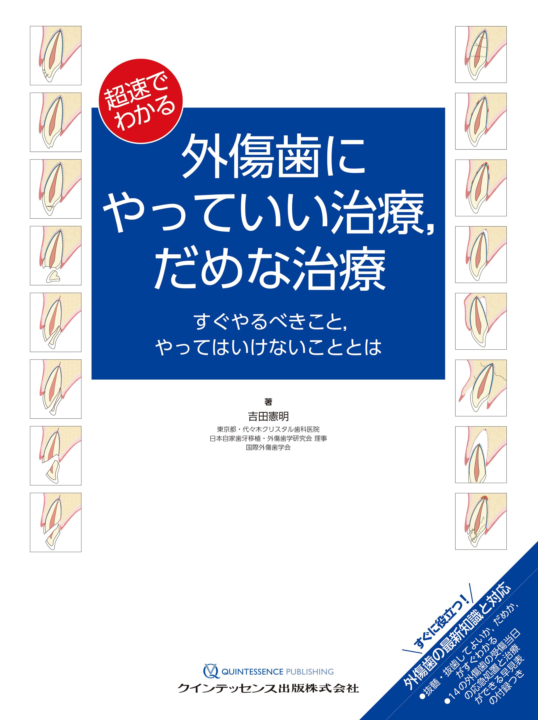 【裁断済み】抜歯手術 上 口腔外科ポイントマスター vol.2 超速でわかる 外傷歯にやっていい治療,だめな治療: すぐやるべきこと